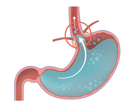 深談新時代流行病之一的“胃食道逆流”